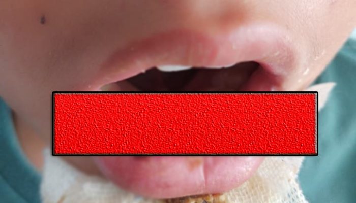 Harapan Jadi Hafidz Pupus, Santri Cilik  Kapok Mondok Lagi, Pulang dengan Luka Jahitan di Mulut